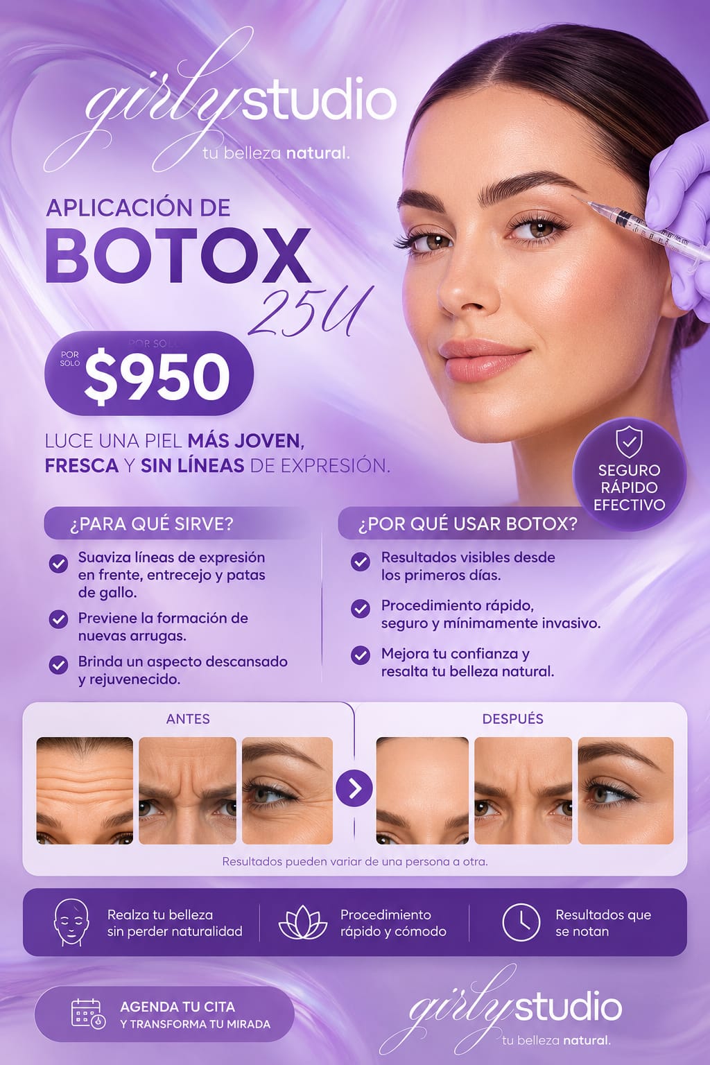 BOTOX 25U aplicacion